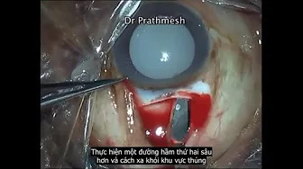 [Phần 1] Hướng dẫn cách xử trí các biến chứng mổ lấy Thể Thủy Tinh của phương pháp MSICS