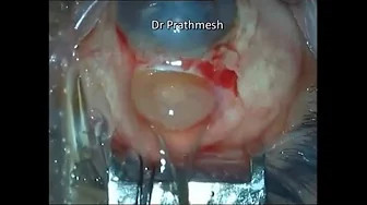 [Phần 2] Hướng dẫn cách xử trí các biến chứng mổ lấy Thể Thủy Tinh của phương pháp MSICS