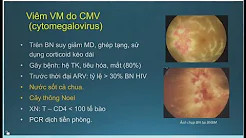 Viêm Màng Bồ Đào Sau: Chẩn Đoán Và Điều Trị - BSCKII.Lê Việt Sơn